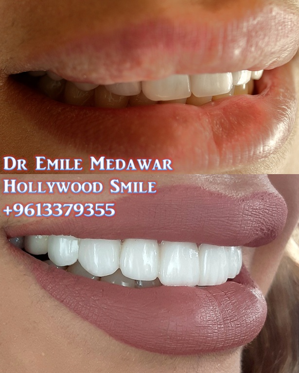 Dental Implants in Lebanon Beirut